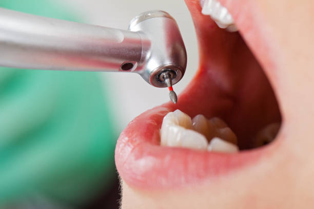 Best Walk-In Emergency Dentist in Beardstown, IL